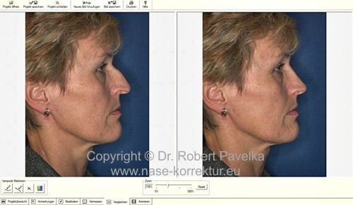 Patientin mit Höckernase